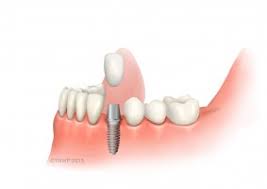 So you have been wondering if you should go in for dental implants, but were a bit worried if getting dental implants placed will hurt, or that the implants would give you pain afterwards. What To Expect After Dental Implant Treatment Aftercare Healing Cleaning Long Term Care
