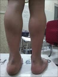 Duchenne Muscular Dystrophy Pediatrics Orthobullets