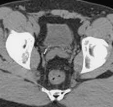 Image result for Helical CT Urogram