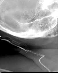 Broken Vp Shunt Radiology Case Radiopaedia Org