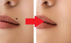You may get a scar where the mole used to be but it shouldn't be anything too bad. 3 Facial Mole Removal Remedies For At Home Facial Mole Mole Removal Facial Mole Removal