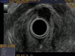 El síndrome carcinoide ocurre en muy pocas personas con tumores carcinoides, después de que el tumor se ha diseminado al hígado o al pulmón. Tumor Carcinoide Acad