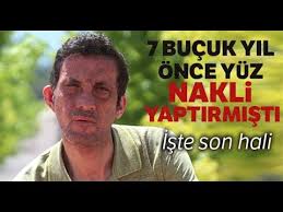 Yuz Nakilli Ugur Acar In Tek Hayali Evlenip Cocuk Sahibi Olmak Youtube