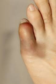 Broken toe treatment & healing time. How To Treat A Broken Pinky Toe Foot Doctor In Chanhassen