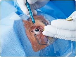 Image result for Cataract Extraction