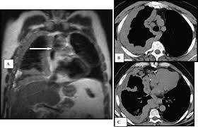 Differential diagnosis of cystic pelvic masses. References In Morphologic And Functional Imaging Of Malignant Pleural Mesothelioma European Journal Of Radiology