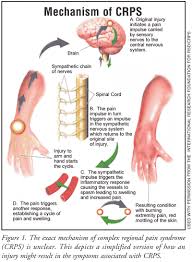 Understanding The Pharmacologic Therapy For Patients Afflicted With Complex Regional Pain Syndrome