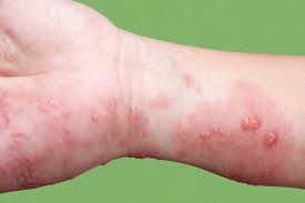 Image result for herpes zoster