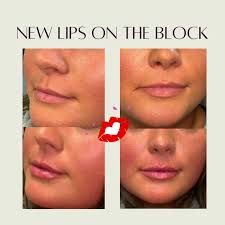 The goal was symmetry and subtle plumping for this first time client!  Loving her natural results 👄, #lipfiller #juvedermlips #npinjector  #naturallipfiller #plumplips #cosmeticinjectables ...