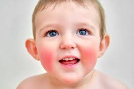 Image result for vyrážka u dětí