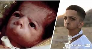 Remember The Baby Without A Mouth, See How He Looks Now And His Career