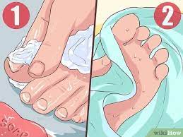 3 Ways To Treat A Torn Toenail Wikihow