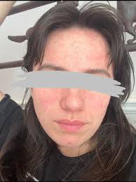 Those with bad facial psoriasis that use foundation to cover it, please  help lol My holy grail foundation that was full coverage and didnt cling to  my patches was discontinued. Who has