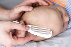 Image result for Cradle Cap