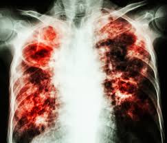 In fact, most people who get infected with. Tuberculosis Laptrinhx News