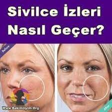 Yuzdeki Sivilce Lekeleri Nasil Gecer Dogal Maske Tarifleri Yuzdekisivilce Sivilce Sivilcenasilgecer Sivilcelekeler Sivilce Izi Cilt Urunleri Cilt Bakimi