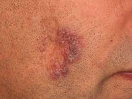 * forma verrugosa = acantosis, hiperqueratosis e infiltrado abundante en la. Tuberculosis Cutis Luposa Altmeyers Encyclopedia Department Dermatology