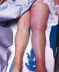 Venous thromboembolism (vte) occurs when blood clots develop in the veins that carry blood to your heart. Trombosis Post Covid Complicacion No Esperada Soy Tu Medico En Casa