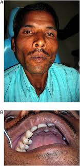 Nasopalatine canal cyst: often missed