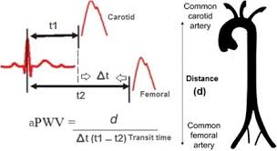 Aortic Pulse Wave Velocity Measurement Apwv Calculated By Dividing The Download Scientific Diagram