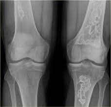 The Radiology Assistant Sclerotic Tumors In 2021 Tumor Radiology Gaucher S Disease