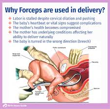 Image result for Forceps Assisted Delivery