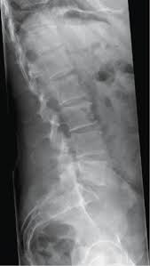 Also, costochondritis can't be observed on tests, so doctors are often hesitant about providing a diagnosis. Adult Elective Orthopaedics And Spine Section 2 Postgraduate Orthopaedics