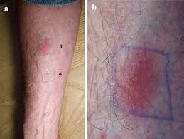 Image result for Pathergy