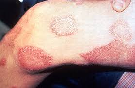 Skin disease, any of the diseases or disorders that affect the human skin. Leprosy Wikipedia
