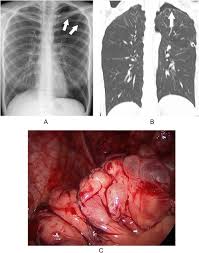 Image result for Pneumothorax