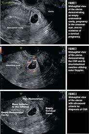 How To Diagnose And Treat Cesarean Scar Pregnancy