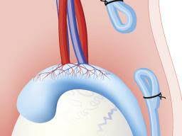 So, how long does a vasectomy take? Vasectomy Reversal Procedure Recovery And Risks