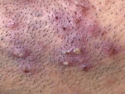 This can cause a painful pink or red bump to appear. Folliculitis Barbae And Pseudofolliculitis Barbae Dermnet Nz