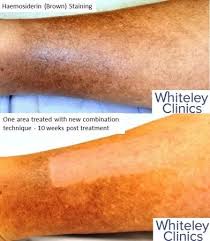 Image result for Pigment stains on the shin