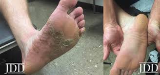 However, unexplained recalcitrant eczema may be associated with an underlying lymphoproliferative malignancy. Recalcitrant Dyshidrotic Eczema Treated With Dupilumab Next Steps In Dermatology