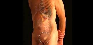 Image result for Inguinal hernia man