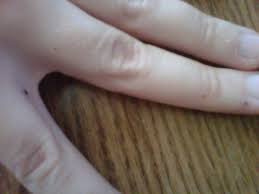If your answer is the black dot, perhaps a little bit of disdain because the dot tainted an otherwise perfectly another black dot: Dark Spot On The Finger Black Dots On The Hands How To Get Rid