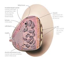 It should be noted that many breast cancer signs and symptoms are also associated with other diseases and conditions and may not necessarily indicate breast cancer. Breast Cancer