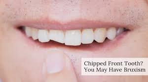Maybe you would like to learn more about one of these? Chipped Front Tooth You May Have Bruxism Michael Sinkin Dds