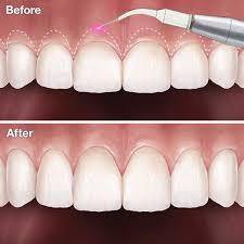 Cắt lợi có đau không? Những điều bạn cần biết về cắt nướu