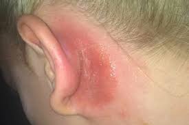 A look at hair dye allergy reactions when someone reacts to the dye they have put on their hair. Teenager Reveals Painful Allergic Reaction To Routine Hair Dye Patch Test Which Saved Her Life Mirror Online