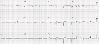 St segment is the flat section of the ecg between end of s and start of the t wave between ventricular depolarization and repolarization ekg. Http Www Siacardio Com Wp Content Uploads 2015 01 A Peculiar And Rare Ecg Behavior In The Acute Coronary Syndrome Pdf