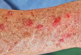 Image result for liver spots on legs