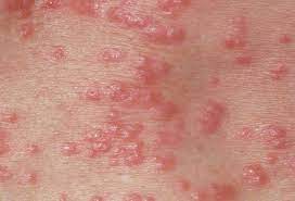 Itchy Bumps Filled With Clear Liquid Causes And Treatment