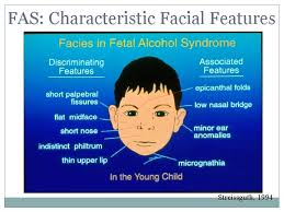 Many affected infants also have unusually flat midfacial regions (midfacial hypoplasia), including a short nose, flattened nasal bridge, and upturned nostrils (anteverted nares); Epicanthal Folds Fas
