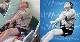 Some childhood epilepsy syndromes are as follows: Why Won T People Talk About Psychogenic Nonepileptic Seizures