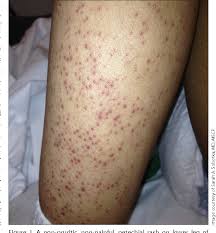 Because of that, you should always have a doctor check petechiae, especially in children. Images Of Petechiae On Face Pet S Gallery