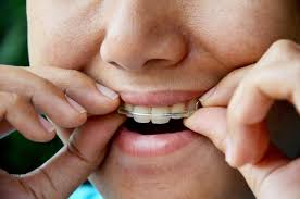 You should feel a little pressure when the braces are being removed, but no pain. How Long Do I Have To Wear My Retainer Why Milnor Orthodontics