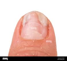 Uno De Los Dedos De La Mano Con Hongos En Las Unas Aislado Fondo Blanco Fotografia De Stock Alamy