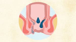 Image result for Hemorrhoid